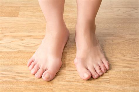 Do Bunions Require Surgery Premier Foot And Ankle Podiatrists