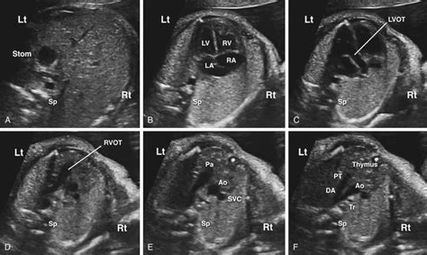 Sonographic Evaluation Of The Fetal Heart Radiology Key