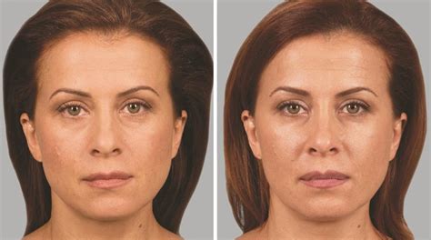 Sculptra Aesthetic Los Angeles Wrinkle Treatment Santa Monica