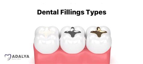Dental Fillings Types Which Is Suitable For You Dental Clinic Turkey