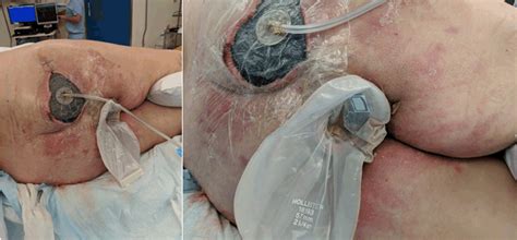 The nurse will have given you instructions specific to your colostomy bag prior to. A novel approach of non-surgical faecal diversion ...