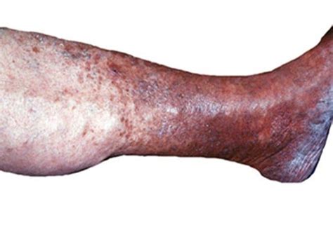 Imddesigncuracao Eczema On Black Skin Leg
