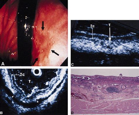 Endoscopic Ultrasonography And Endoscopy For Staging Depth Of Invasion