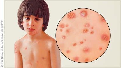 Chickenpox can generally be treated at home with only a small number of cases needing medical attention. Cara Hilangkan Parut Demam Chickenpox | blizful life