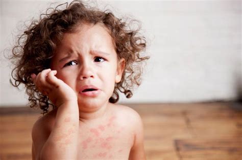 Крапивница аллергическая фото лечение симптомы у детей у взрослых