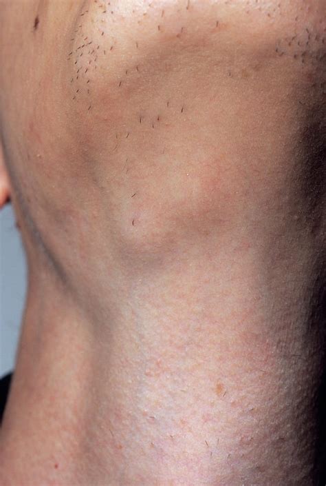Swollen Glands Photograph By Dr P Marazziscience Photo Library