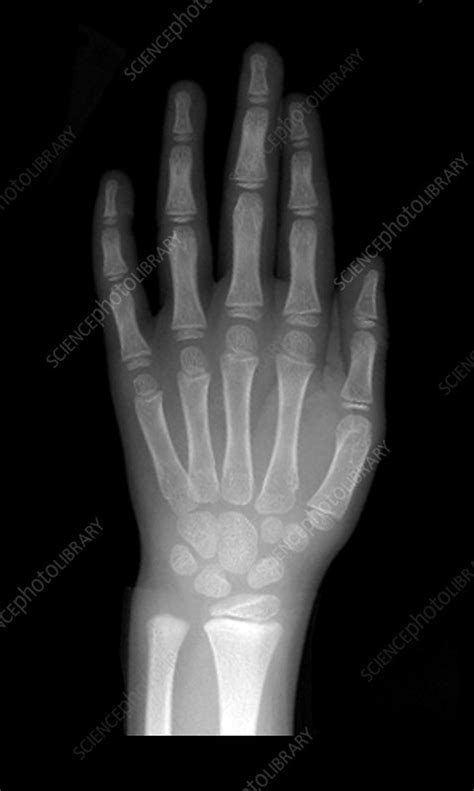 Normal Pediatric Hand X Ray Stock Image C0034588 Science Photo