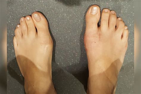 2 Bunion After 6 Weeks Foot And Podiatry Surgery