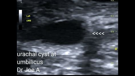 Urachal Cyst At Umbilicus Adult Female Ultrasound Video Youtube