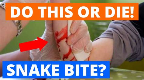 How To SURVIVE A Snake Bite First Aid Treatment At Home In