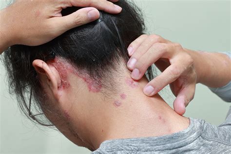 Scalp Psoriasis Back Of Neck And Ear Psoriasis Cure Now