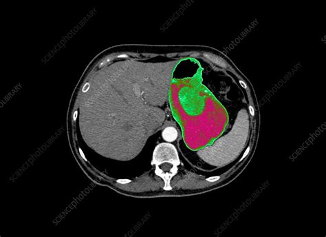 Stomach Cancer Ct Scan Stock Image C0261108 Science Photo Library
