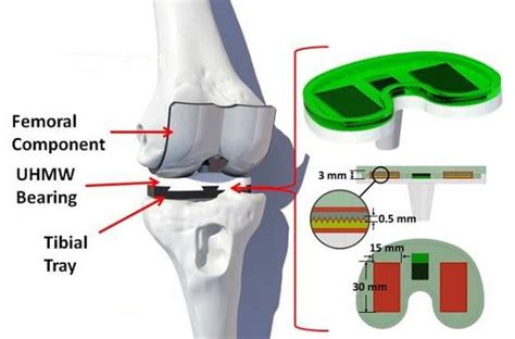 Prototype Smart Bionic Knee Implant Can Power Itself Knee Replacement