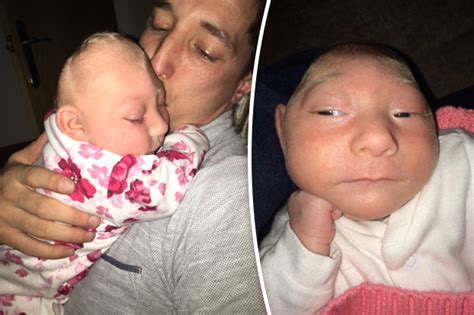 Baby Girl With Half A Head Defies Medic To Survive Daily Star