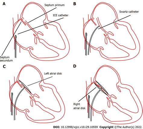 Concept Procedures For Percutaneous Patent Foramen Ovale Closure