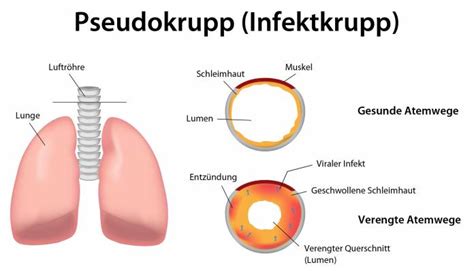Krupp Und Pseudokrupp Ursachen Symptome And Behandlung