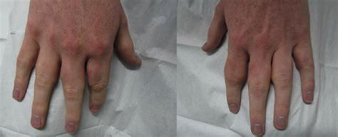 Distinctive Bilateral Swelling Of The Skin Localized To Proximal