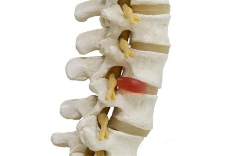 What Is A Herniated Disc And How Is It Treated