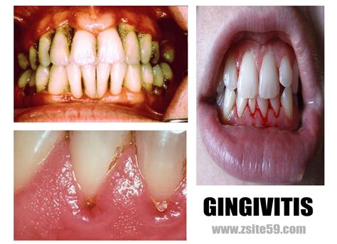 Z59 Faqs And Sheets Of Informations And Stories Gingivitis