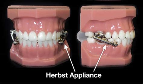 Types Of Appliances West Brook Orthodontic Center Ringwood New Jersey