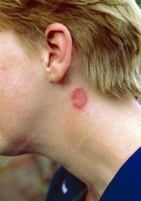 Fungal Infection Ringworm On Neck Stock Image M2700110 Science
