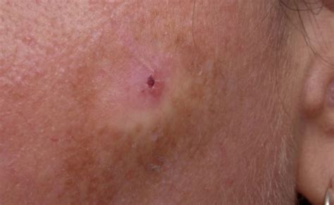 It occurs mostly on parts more exposed to home remedies for actinic keratosis. Laser-Assisted Photodynamic Therapy in Patients With ...