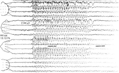 Eeg In The Diagnosis Classification And Management Of Patients With