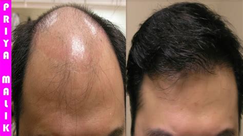 Grow Long Hair 100 Natural Hair Loss Treatment Cure Baldness Remove