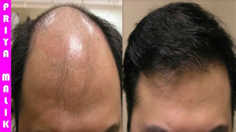 So make sure to use this simple but effective hair loss cure using milk. Grow Long Hair, 100% Natural Hair Loss Treatment, Cure ...