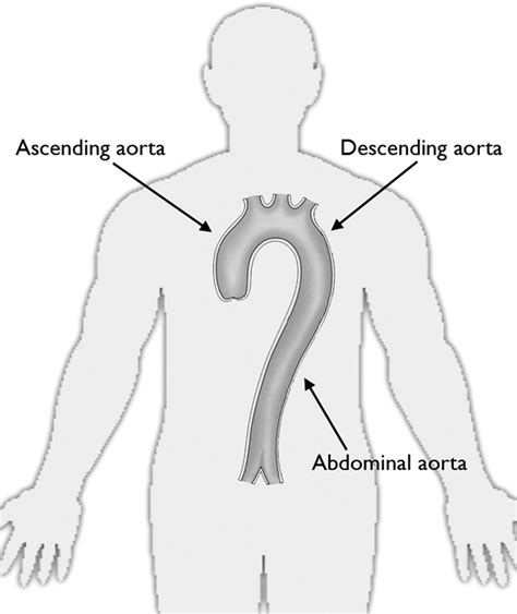 Aortic Dissection Circulation