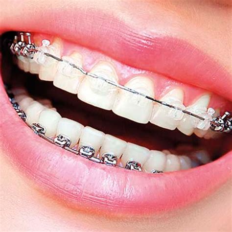 Cuántos tipos de Brackets existen Clínica Dental Nudent TRUJILLO