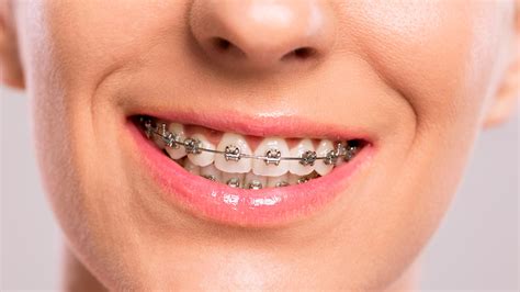 What About Coverage for Braces? | Get a Free Health Insurance Quote