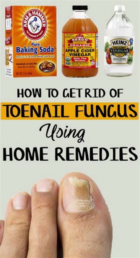 How To Get Rid Of Toenail Fungus 9 Home Remedies Included Facebfit