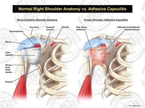 Normal Right Shoulder Anatomy Vs Adhesive Capsulitis