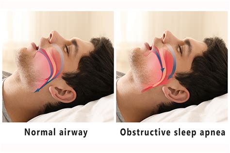 How Nasal Congestion Increases Sleep Apnoea Uk