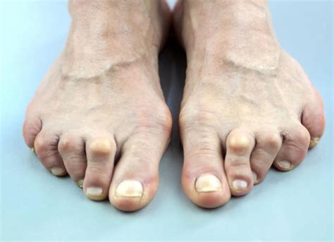 Claw Toe Exercises And Prevention Of Deformity Podexpert