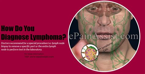 How Do You Diagnose Lymphoma