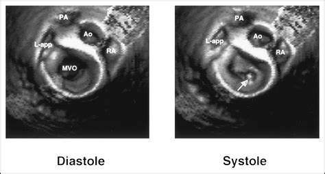 Assessment Of Flail Mitral Leaflets By Dynamic Three Dimensional