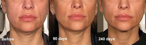 Ultherapy Jowl Lift And Skin Tightening In Edinburgh