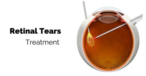 Learn About Your Eye If You Have A Retinal Tear