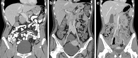 Abdominal And Pelvic Ct Is Positive Enteric Contrast Still Necessary