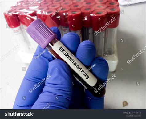 Blood Sample Her2 Breast Cancer Testing Stock Photo 2149248433