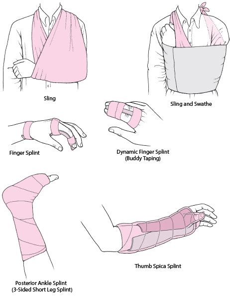 Figure Joint Immobilization As Acute Treatment Some Commonly Used