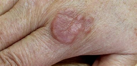 Disease Of The Week Granuloma Annulare Elect Dermatology