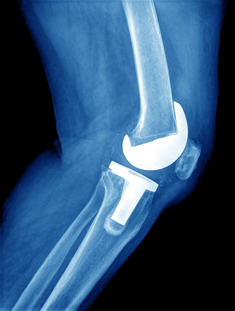 Knee Replacement X Ray The Orthopedic And Sports Medicine Institute In