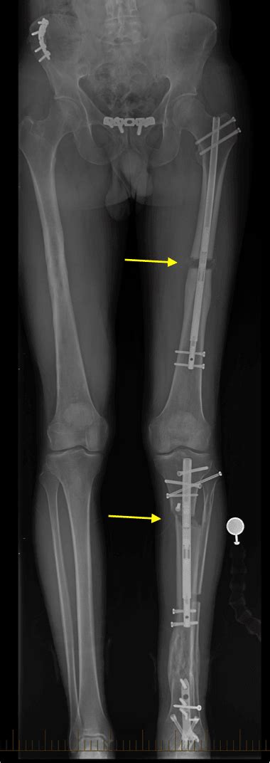 Malunion In The Lower Limb Orthoinfo Aaos