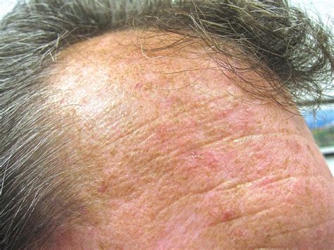 Aktinische Keratose Symptome And Therapie Online Hautarzt Appdoc