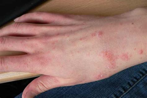 Dry Skin Rash Protective Tips And Treatments Part 2