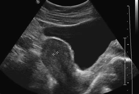 Uterus Positions On Ultrasound