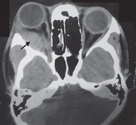 Contrast Enhanced Computed Tomography Of The Orbit Axial Scan Shows A